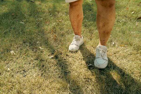 Can Kidney Stones Cause Edema?